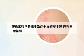 環(huán)孢素和甲氨喋呤治療牛皮癬哪個好 環(huán)孢素 甲氨蝶
