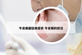 牛皮癬最輕微癥狀 牛皮癬的狀況