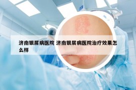 濟南銀屑病醫(yī)院 濟南銀屑病醫(yī)院治療效果怎么樣