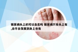 銀屑病頭上的可以自愈嗎 銀屑病只有頭上有,會(huì)不會(huì)發(fā)展到身上也有
