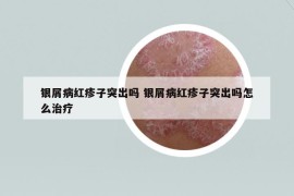 銀屑病紅疹子突出嗎 銀屑病紅疹子突出嗎怎么治療