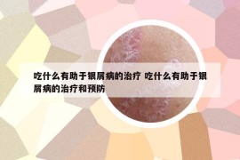 吃什么有助于銀屑病的治療 吃什么有助于銀屑病的治療和預(yù)防