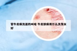 管牛皮癬洗面奶叫啥 牛皮膚癬用什么洗發(fā)水好
