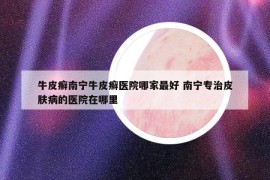 牛皮癬南寧牛皮癬醫(yī)院哪家最好 南寧專(zhuān)治皮膚病的醫(yī)院在哪里