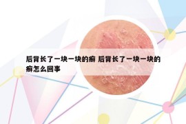 后背長了一塊一塊的癬 后背長了一塊一塊的癬怎么回事