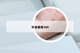 牛皮癬用308