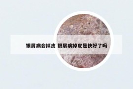 銀屑病會(huì)掉皮 銀屑病掉皮是快好了嗎