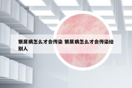 銀屑病怎么才會傳染 銀屑病怎么才會傳染給別人