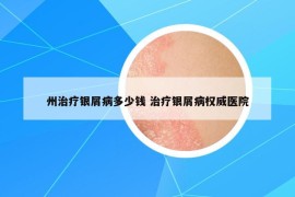 州治療銀屑病多少錢 治療銀屑病權(quán)威醫(yī)院