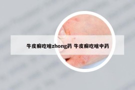 牛皮癬吃啥zhong藥 牛皮癬吃啥中藥