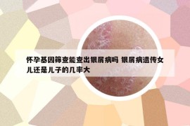 懷孕基因篩查能查出銀屑病嗎 銀屑病遺傳女兒還是兒子的幾率大