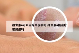 維生素a可以治療牛皮癬嗎 維生素a能治療銀屑病嗎