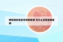 哪些因素感染導(dǎo)致銀屑病 為什么會感染銀屑病