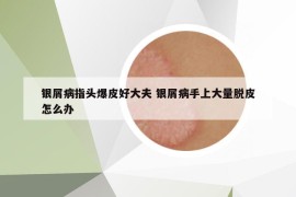 銀屑病指頭爆皮好大夫 銀屑病手上大量脫皮怎么辦