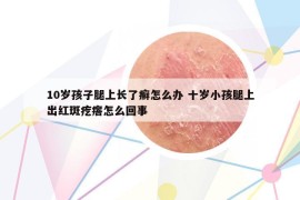 10歲孩子腿上長了癬怎么辦 十歲小孩腿上出紅斑疙瘩怎么回事