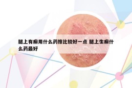 腿上有癬用什么藥擦比較好一點(diǎn) 腿上生癬什么藥最好