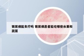銀屑病能食療嗎 銀屑病患者能吃哪些水果和蔬菜