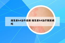 維生素k4治牛皮癬 維生素k4治療銀屑病嗎