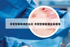 尋常型銀屑病惡化紅 尋常型銀屑病全身爆發(fā)