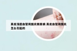 真皮淺層血管周圍炎銀屑病 真皮血管周圍炎怎么引起的