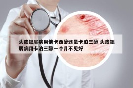 頭皮銀屑病用他卡西醇還是卡泊三醇 頭皮銀屑病用卡泊三醇一個(gè)月不見(jiàn)好