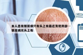 本人患有銀屑病只有頭上有最近發(fā)現(xiàn)陰部… 銀屑病光頭上有