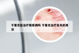 千里光能治療銀屑病嗎 千里光治療皮炎的用法