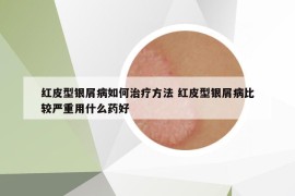 紅皮型銀屑病如何治療方法 紅皮型銀屑病比較嚴(yán)重用什么藥好