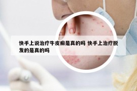 快手上說治療牛皮癬是真的嗎 快手上治療脫發(fā)的是真的嗎
