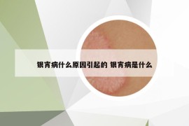 銀宵病什么原因引起的 銀宵病是什么