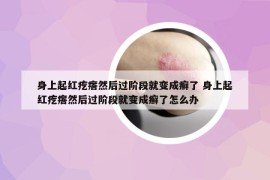 身上起紅疙瘩然后過階段就變成癬了 身上起紅疙瘩然后過階段就變成癬了怎么辦
