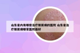 山東省內(nèi)有哪些治療銀屑病的醫(yī)院 山東省治療銀屑病哪家醫(yī)院最好