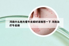 河南什么地方看牛皮癬好請推薦一下 河南治療牛皮癬