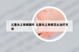 兒童頭上有癬圖片 兒童頭上有癬怎么治療方法
