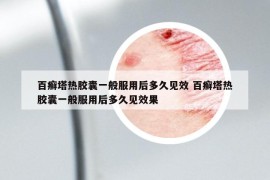 百癬塔熱膠囊一般服用后多久見效 百癬塔熱膠囊一般服用后多久見效果