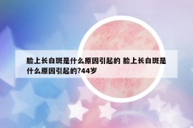 臉上長白斑是什么原因引起的 臉上長白斑是什么原因引起的?44歲