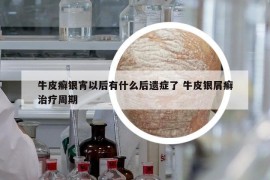 牛皮癬銀宵以后有什么后遺癥了 牛皮銀屑癬治療周期