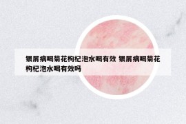 銀屑病喝菊花枸杞泡水喝有效 銀屑病喝菊花枸杞泡水喝有效嗎