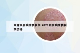 太原銀屑病生物制劑 2021銀屑病生物制劑價格