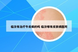 臨汾有治療牛皮癬的嗎 臨汾哪有皮膚病醫(yī)院