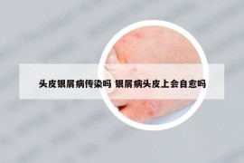 頭皮銀屑病傳染嗎 銀屑病頭皮上會自愈嗎