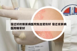 宿遷好的銀屑病醫(yī)院甄選楚街好 宿遷皮膚病醫(yī)院哪家好