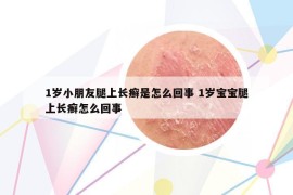 1歲小朋友腿上長癬是怎么回事 1歲寶寶腿上長癬怎么回事