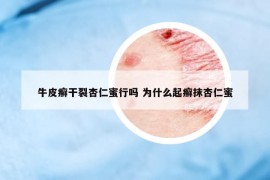 牛皮癬干裂杏仁蜜行嗎 為什么起癬抹杏仁蜜
