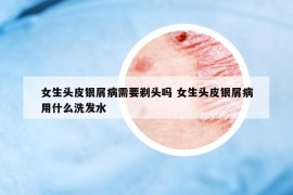 女生頭皮銀屑病需要剃頭嗎 女生頭皮銀屑病用什么洗發(fā)水