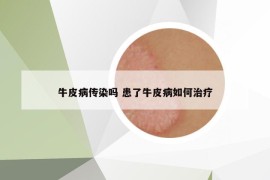 牛皮病傳染嗎 患了牛皮病如何治療