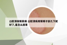 口腔潰瘍銀屑病 口腔潰瘍用銀鐲子刮幾下就好了,是怎么回事