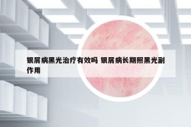 銀屑病黑光治療有效嗎 銀屑病長(zhǎng)期照黑光副作用