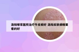 洛陽哪家醫(yī)院治療牛皮癬好 洛陽皮膚病哪里看的好