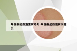 牛皮癬的血液里有毒嗎 牛皮癬是血液有問題么